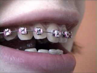 braces.jpg