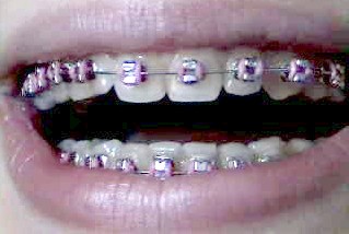 braces010504.jpg