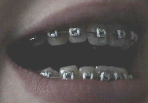 braces060504-023.jpg