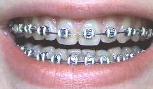 braces210504-02.jpg